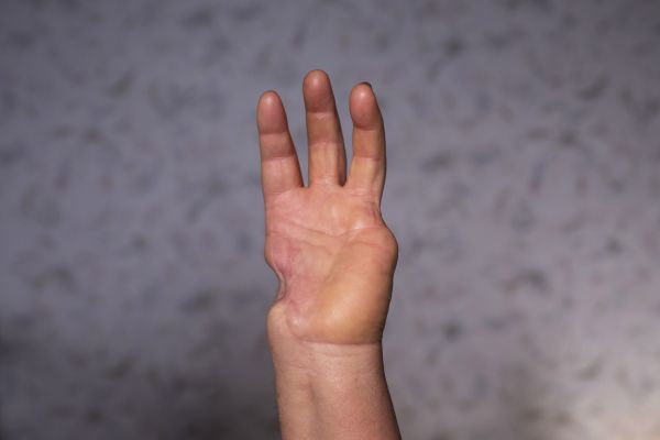 Tamara Honcharovska (Gontscharow) lost her thumb and pinky due to injuries she sustained from an explosion in her backyard while she took a shower in the village of Opytne.