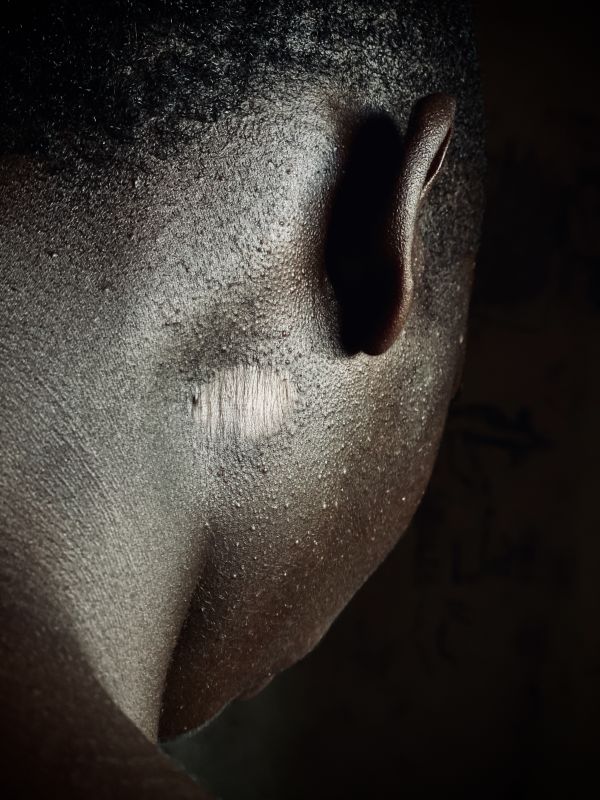 An adolescent show the scar from a built that passed through his neck.